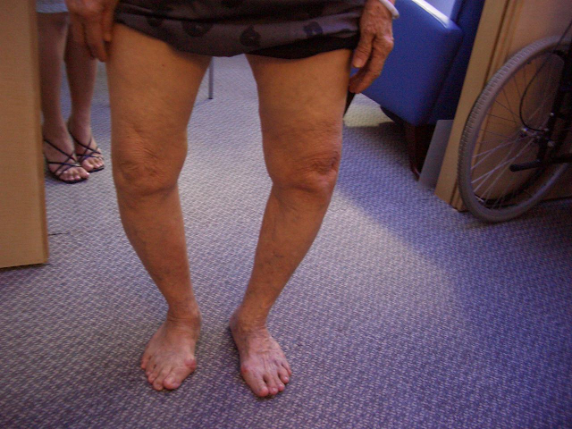Embrace an Active and Fulfilling Life with Osteoarthritis of Both Knees