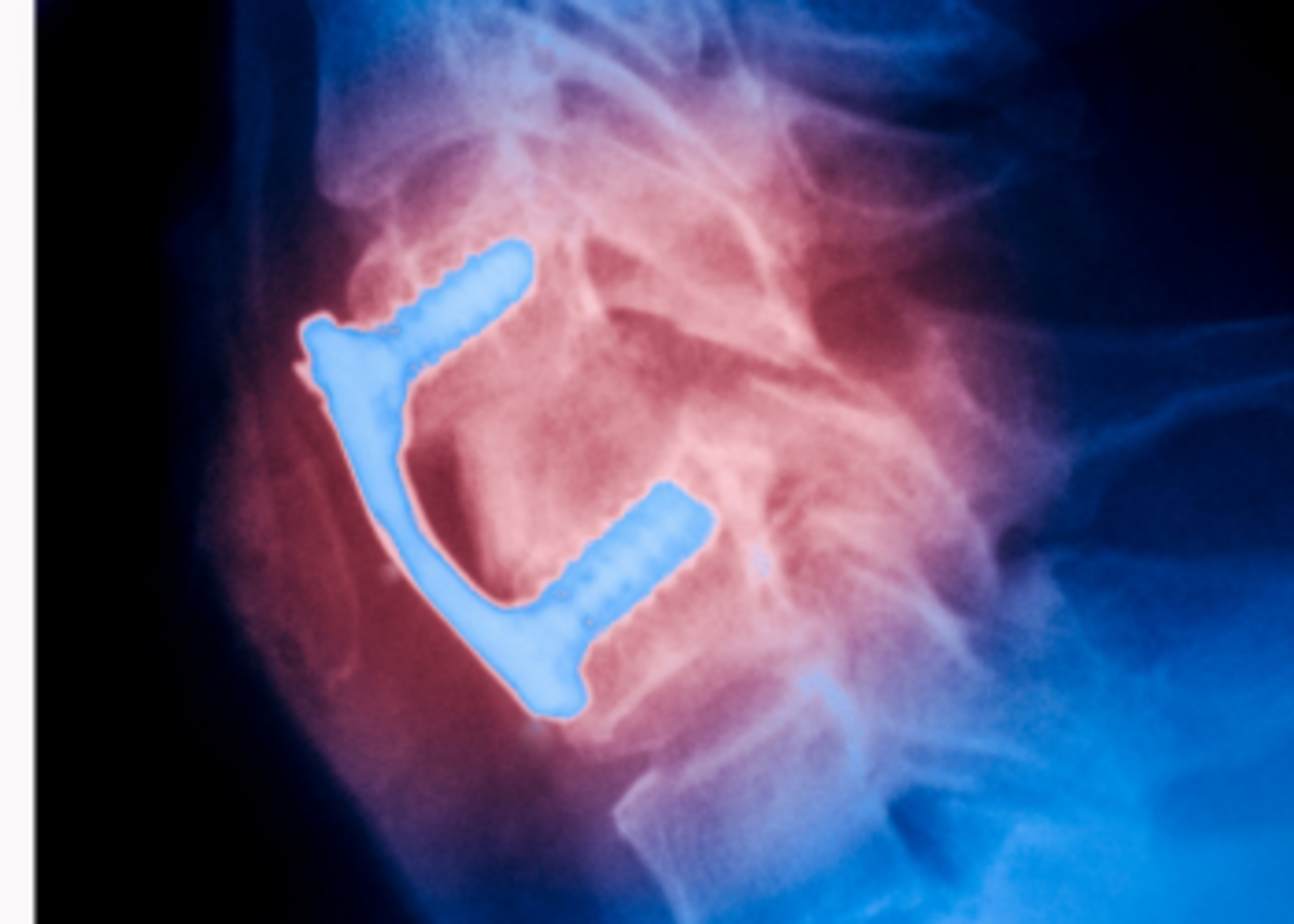 Anterior Cervical Discectomy Fusion ( ACDF )