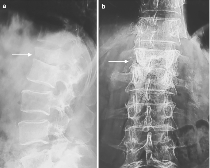 X-Ray