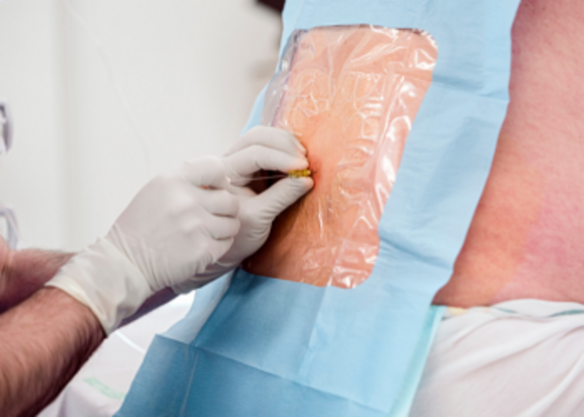 Paraspinal Injections - Facet Joint and Nerve Root Blocks