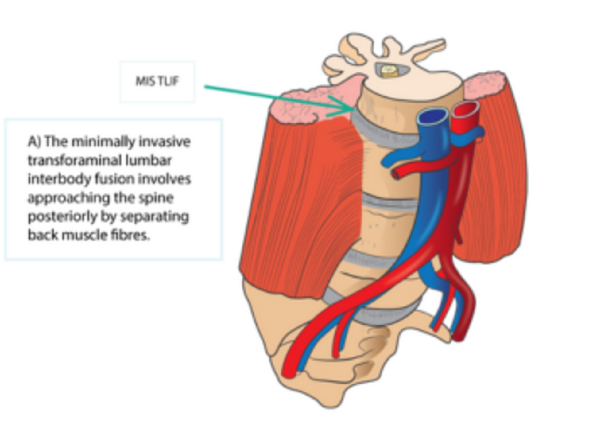 Minimally Invasive Transforaminal Lumbar Interbody Fusion ( MIS TLIF )