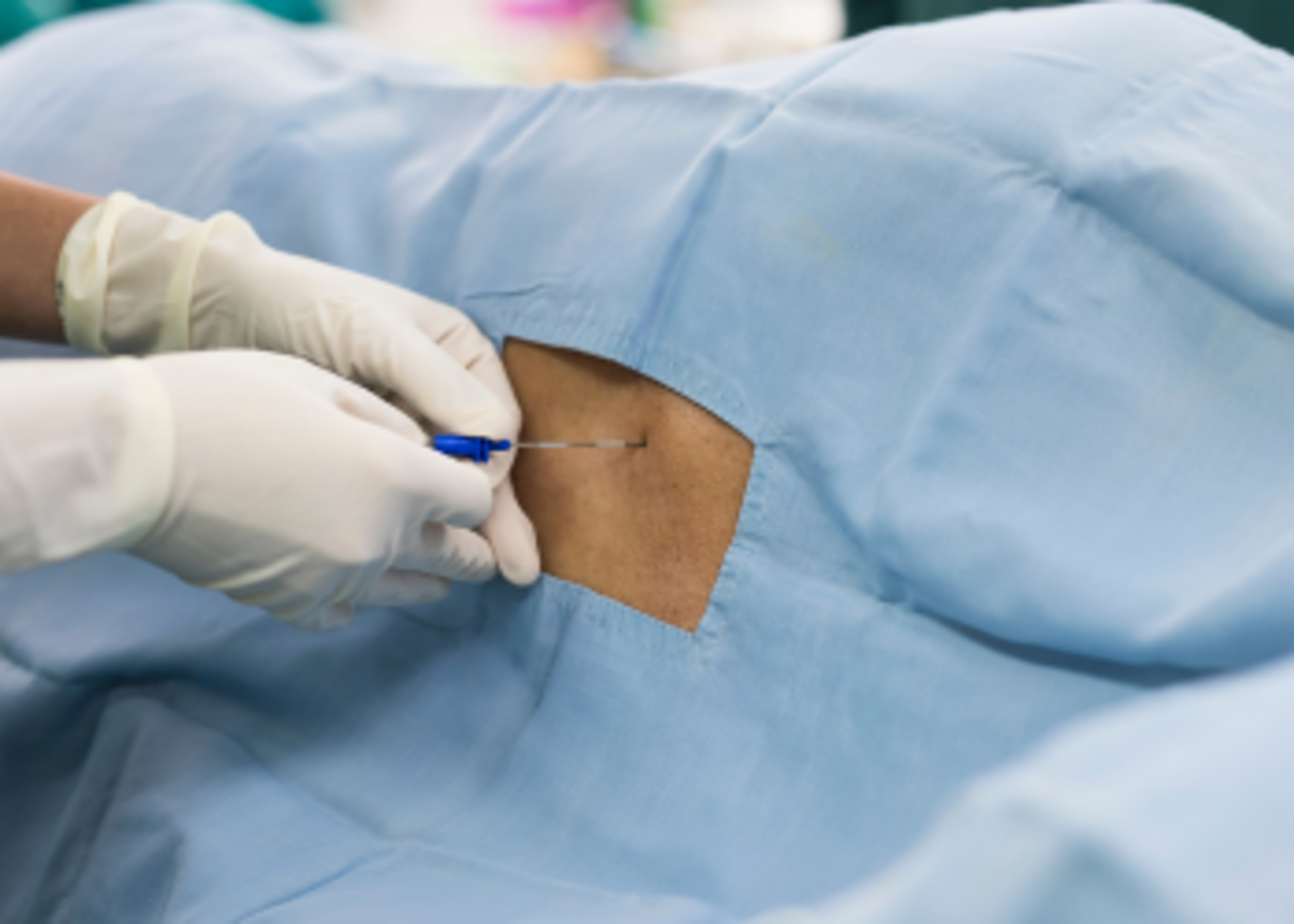 Transforaminal Lumbar Epidural Block