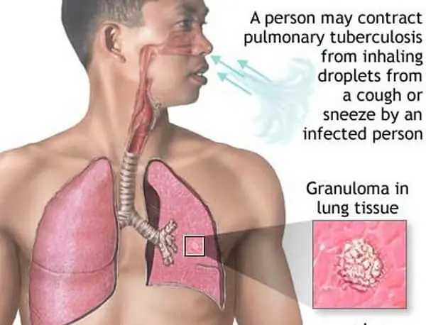Causes of Spine Tuberculosis